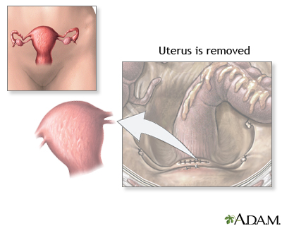 hysterectomy sex drive Hysterectomy sex drive