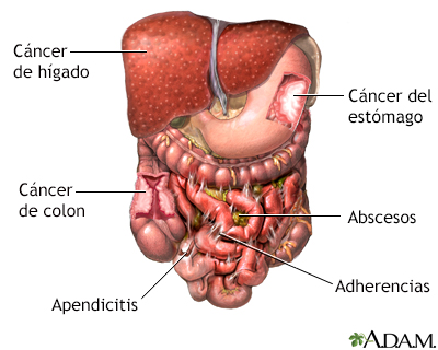 Cancer de colon higado